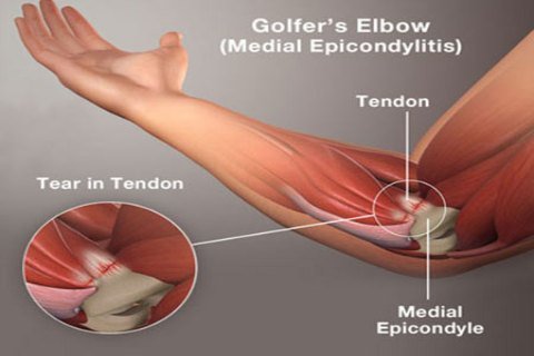 GOLFERS ELBOWMEDIAL EPICONDYLITI