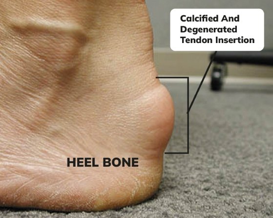 Achilles heal bone