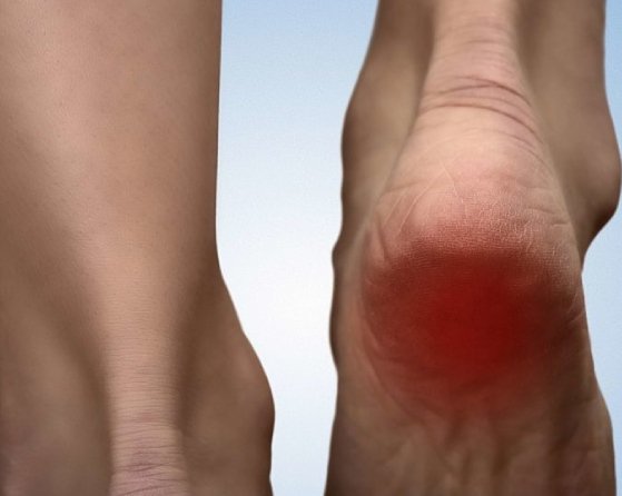 CAUSES OF HEEL PAIN
