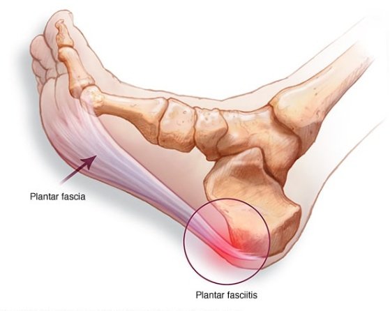 plantar1