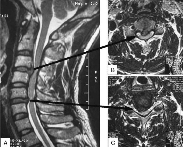 Cervical spondylosis ABC