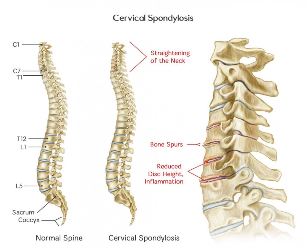 Normal Cervical spondylosis