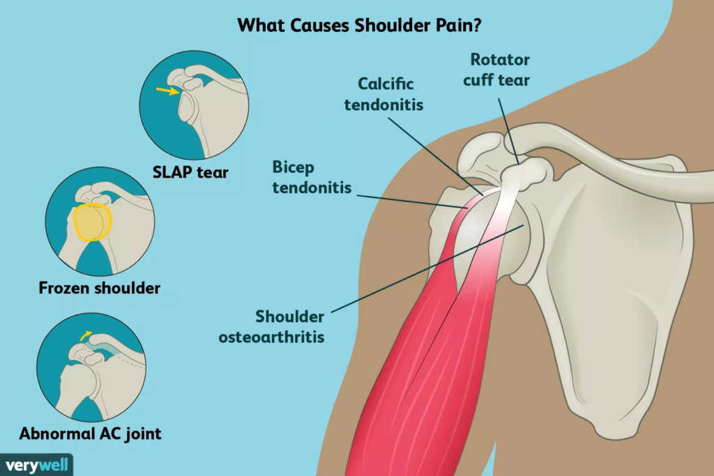 Shoulder-pain