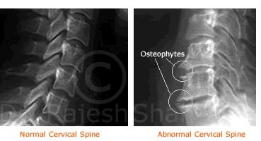 Abnormal Cervical spine