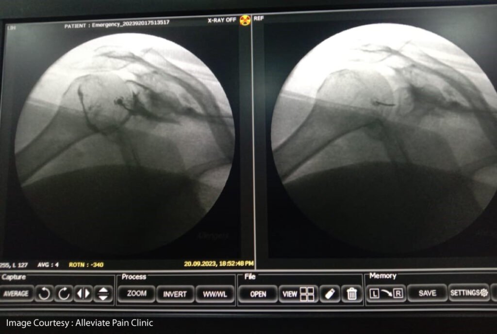 HYDRODILTATION UNDER FLUOROSCOPIC GUIDANCE