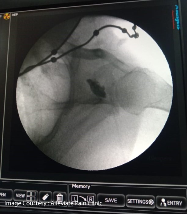 Suprascapular Nerve Block using Fluoroscopy