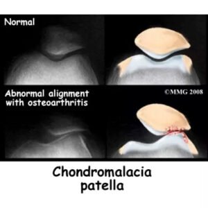 chondromalacia patella