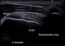 Supraspinatus long