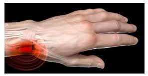 De-Quervains-Tenosynovitis2