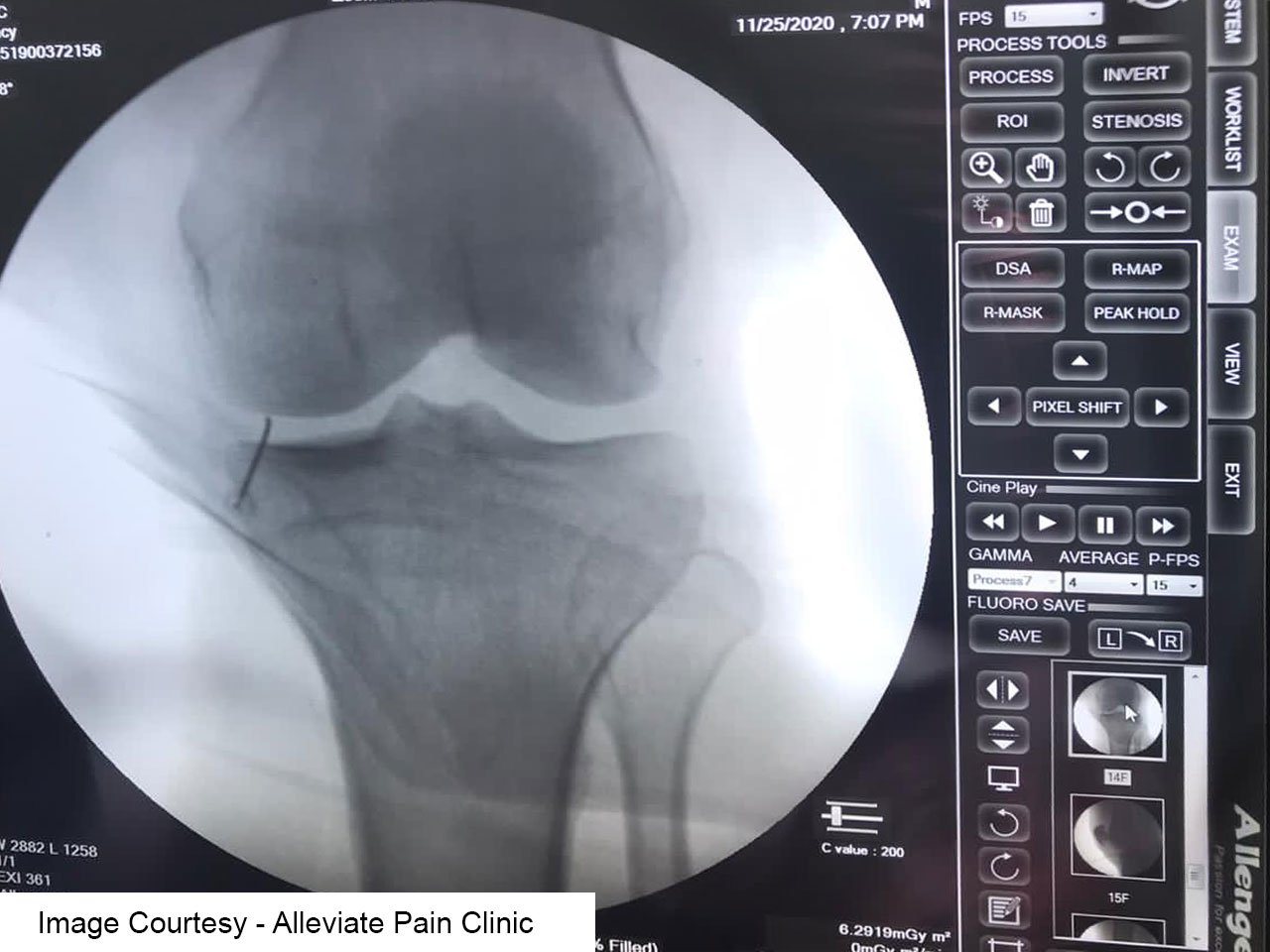 Platelet rich plasma