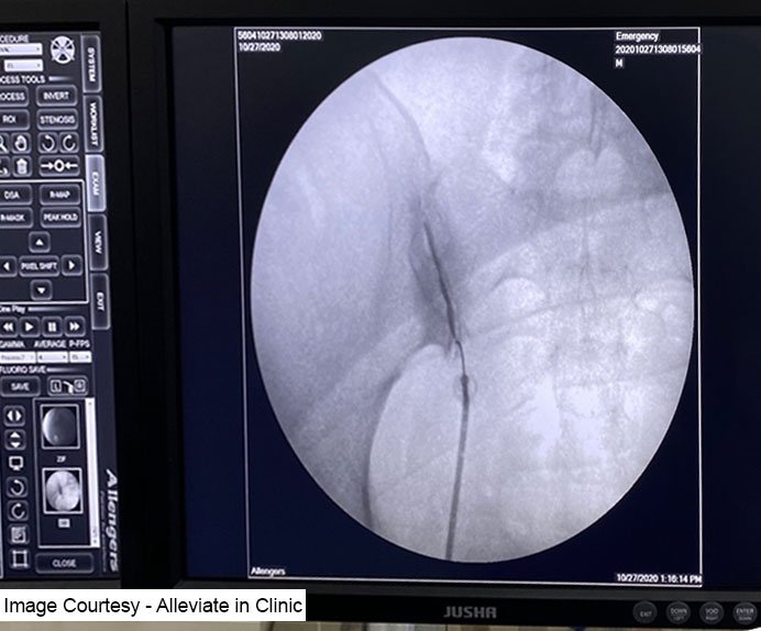 Fluoroscopy guided intrarticular Sacroiliac joint injection